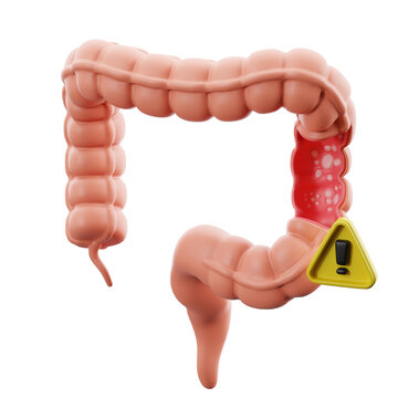Ulcerative colitis with warning sign. 3d illustration