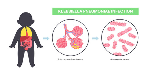 Klebsiella pneumoniae poster