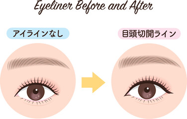 アイライン　ビフォーアフター　目頭切開ライン