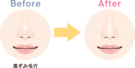 Fototapeta premium 鼻の毛穴トラブル ビフォーアフター｜黒ずみ毛穴