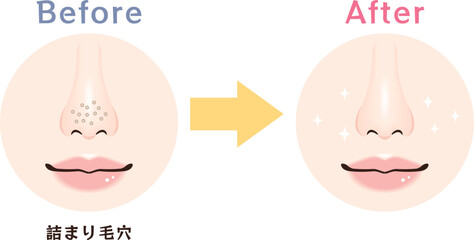 Fototapeta premium 鼻の毛穴トラブル ビフォーアフター｜詰まり毛穴