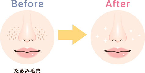 鼻の毛穴トラブル　ビフォーアフター｜たるみ毛穴