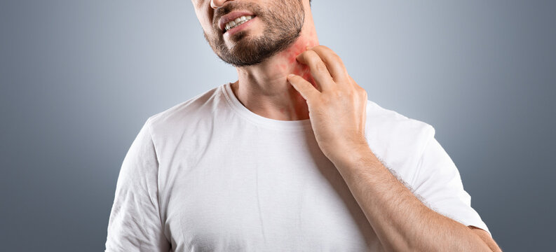 Middle aged bearded man scratching highlighted with red neck on grey studio background, copy space. Annoyed man suffering from itch, having rash on his neck. Allergic reaction, eczema concept