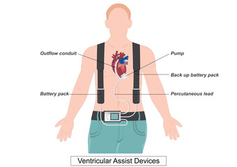 A ventricular assist device (VAD) is a device that helps pump blood.