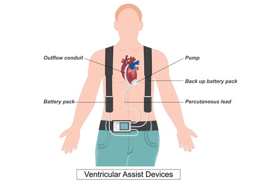 A ventricular assist device (VAD) is a device that helps pump blood.