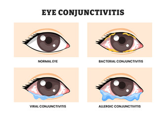 Different types of Eye Conjunctivitis types, educational medical poster design healthcare scheme, labeled Normal Eye, Bacterial, Viral, and Allergic Conjunctivitis Symptoms. Ophthalmology Illustration