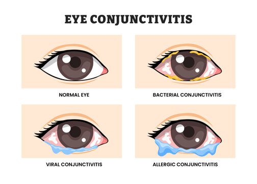 Different types of Eye Conjunctivitis types, educational medical poster design healthcare scheme, labeled Normal Eye, Bacterial, Viral, and Allergic Conjunctivitis Symptoms. Ophthalmology Illustration