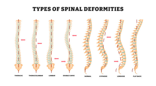 Different types of spinal deformities types, educational medical poster design healthcare scheme, labeled thoracic, thoracolumbar, lumbar, double curve, normal, kyphosis, lordosis, flat back. 
