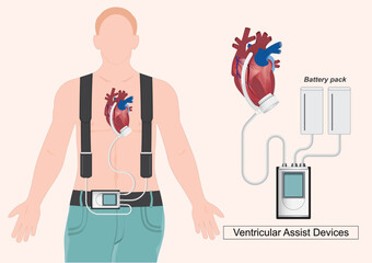 A Ventricular Assist Device (VAD) is a mechanical pump.