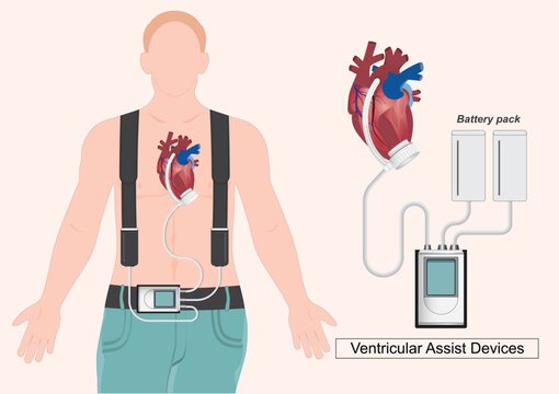 A Ventricular Assist Device (VAD) is a mechanical pump.