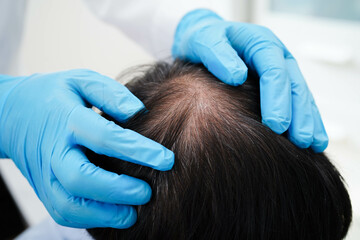 Doctor touch bold head in man, hair loss treatment health problem.