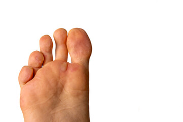 Human foot affected by blisters due to medical condition known as fallen arches or flat feet