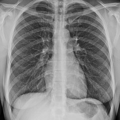 Real Chest X-Ray Scam Showing Ribcage and Lung Structure in Frontal view