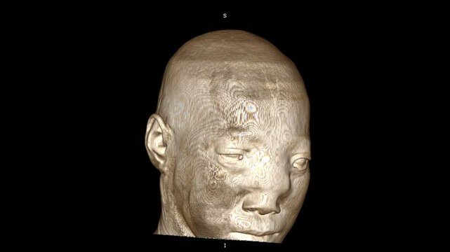 Meningocele ,Cranial CT findings in patients with meningomyelocele 3D rendering 