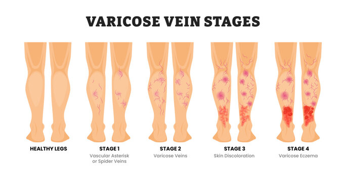 Stages of varicose vein stages, educational medical poster design healthcare scheme, labeled vascular asterisks reticular veins venous insufficiency trophic ulcers, skin discoloration, varicose eczema
