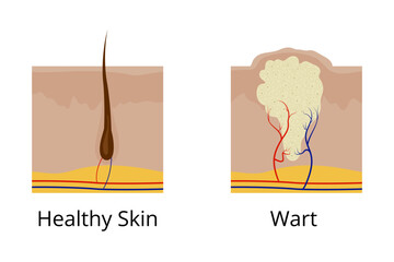 Obraz premium Healthy skin and wart comparison showing arteries and veins