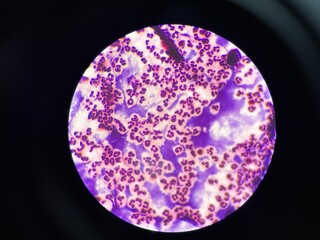 The slide shows a large number of white blood cells, appearing as round or irregularly shaped cells with distinct nuclei. These cells are scattered across the field.