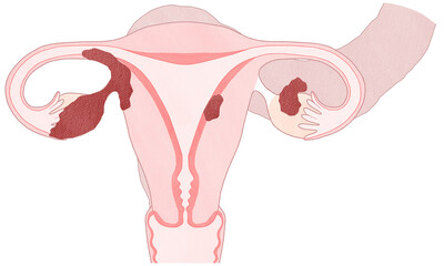 Blank Ovarian cancer Stage 2 diagram