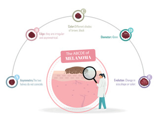 Doctor showing melanoma symptoms using magnifying glass