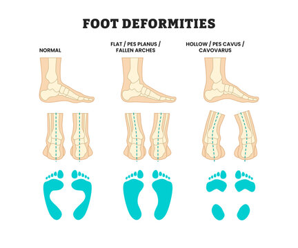 Different types of foot deformities types, educational medical poster design healthcare Orthopedic, Flatfoot (Pes Planus), High Arch (Pes Cavus), and Normal Foot Comparison Skeleton and Footprint.