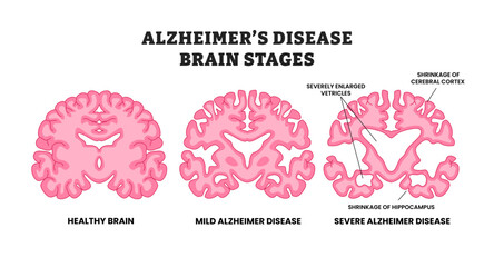 Stages of Alzheimer's disease stages, educational medical poster design healthcare scheme, labeled Human brain cross section, affected with progressive neurodegenerative disease, severe, mild.