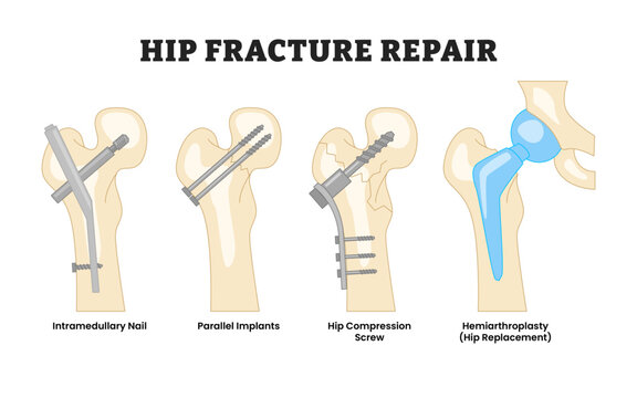 Different types of hip fracture repair types, educational medical poster design healthcare scheme, labeled intramedullary nail, parallel implant, hip compression screw, hemiarthroplasty. Bone Fracture