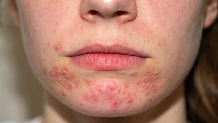 Fototapeta premium Close-Up of Acne on Female Skin Around Chin and Mouth Area with Red Bumps