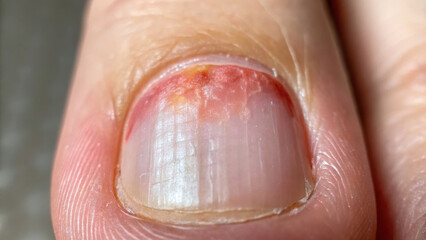 Obraz premium close up view of fingernail showing signs of irritation and possible fungal infection affecting scalp and skin
