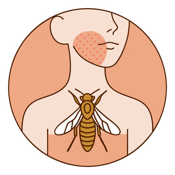 Bee on human chest with allergic skin rash illustration