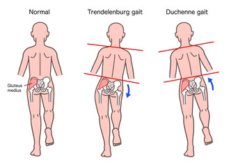 トレンデレンブルグ徴候とデュシェンヌ徴候の人体