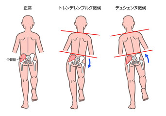 トレンデレンブルグ徴候とデュシェンヌ徴候の人体