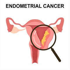 Endometrial Cancer. Vector Uterus Cross Section with Anatomy. Uterine cancer.	