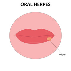Oral herpes vector illustration