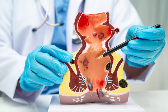 Asian doctor with rectum and hemorrhoid human anatomy model at hospital, inflamed vascular structure.