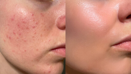 Realistic close-up of female face showing acne before and after skincare treatment. Visible pore...