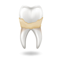 Realistic illustration of human tooth with yellowish plaque or tartar buildup showing dental health concept on white background. Useful for dental care education or medical articles.