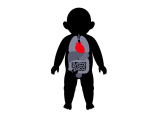 Heart disease in a child