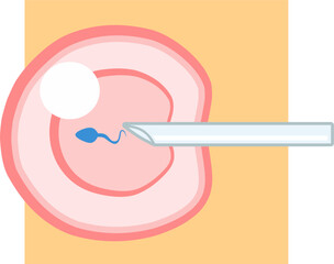 IVF ICSI vector illustration with orange square background. Perfect for presenting anything about reproduction.