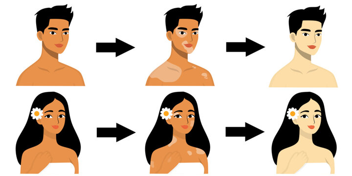 vitiligo process before and after. World Vitiligo day	