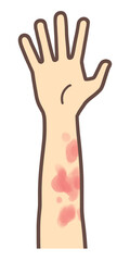 紅斑ができた腕