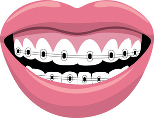  A smile with braces.
Vector close-up illustration of a smiling mouth with metal braces installed on the upper and lower teeth. The white background highlights the elements of orthodontic treatment.