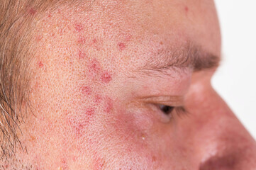 Naklejka premium Red spots and rashes on the scalp and eyes. Alcohol intolerance, alcoholic urticaria, allergies, close-up