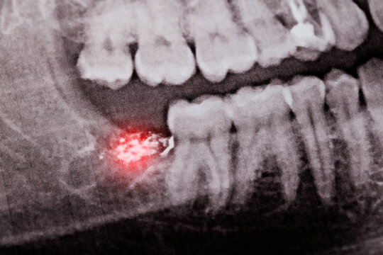 Red inflamed tooth socket with medicine after wisdom tooth removal on x-ray images. Complication of the tooth socket, alveolitis, close-up