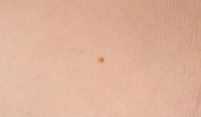 Skin mole spot closeup. Human birthmark, nevus macro texture