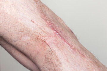 Close-up of the leg of an adult Caucasian man with a big keloid scar on the skin of his leg after a burn.	