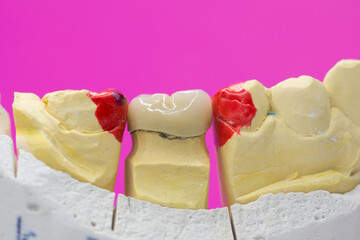 Metal-ceramic dental crown is tried