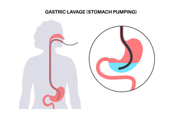 Stomach wash gastric lavage