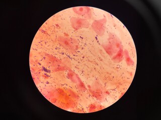 Mixed organism bacteria in sputum gram stain.