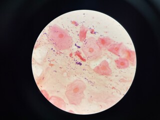 Mixed organism bacteria in sputum gram stain.