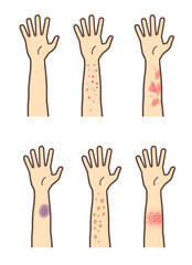帯状疱疹や湿疹、膿疱、アザができた腕のセット